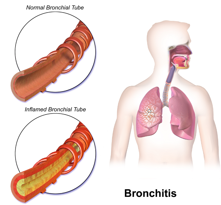 bronkitis - rumah sakit