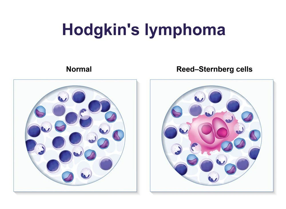 what-is-hodgkin-lymphoma-rumahsakit